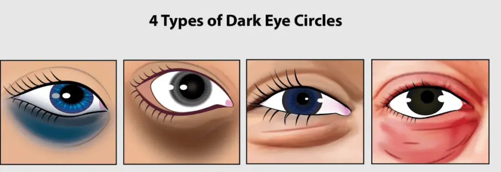 Types of Dark Circles Under the Eyes