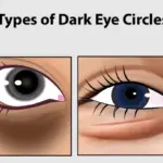 Types of Dark Circles Under the Eyes